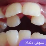 ازدحام و شلوغی دندان