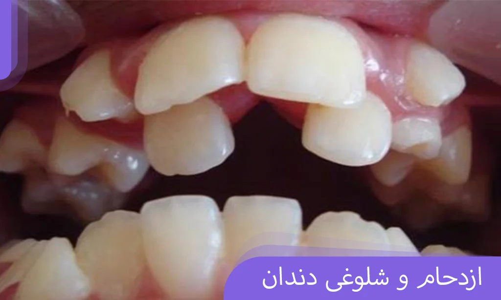 ازدحام و شلوغی دندان