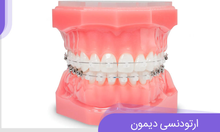 ارتودنسی دیمون