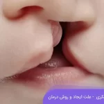 شکاف لب یا لب شکری چیست و چطور درمان می شود؟