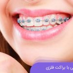 بریس فلزی