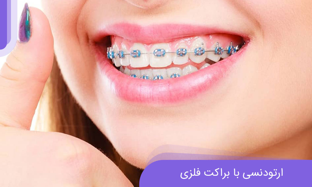 بریس فلزی