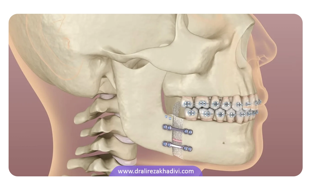 مراحل جراحی ارتوگناتیک