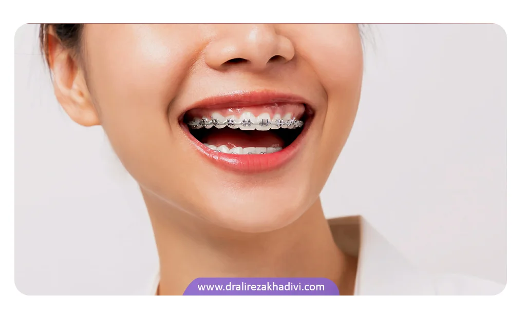 ارتودنسی برای مرتب کردن دندان که باعث طراحی زیبای لبخند می شود