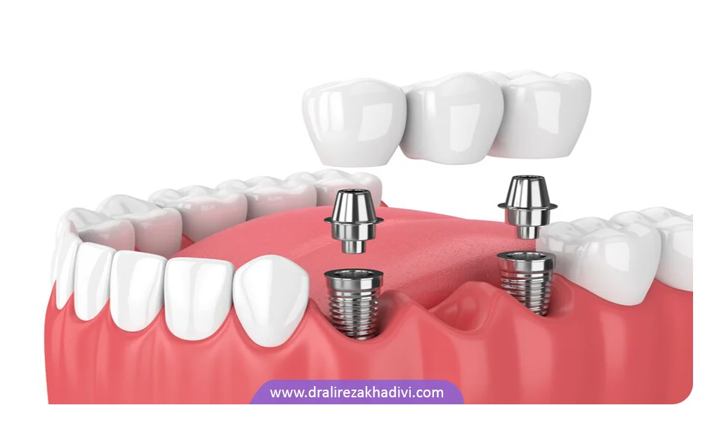 انجام ایمپلنت دندان برای دندان های از دست رفته