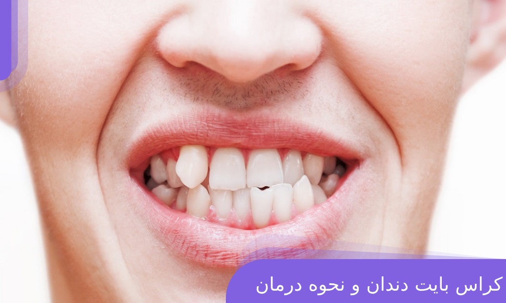 کراس بایت دندان و نحوه درمان آن