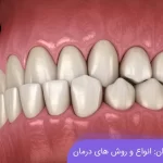 مشکل کراس بایت دندان چیست؟