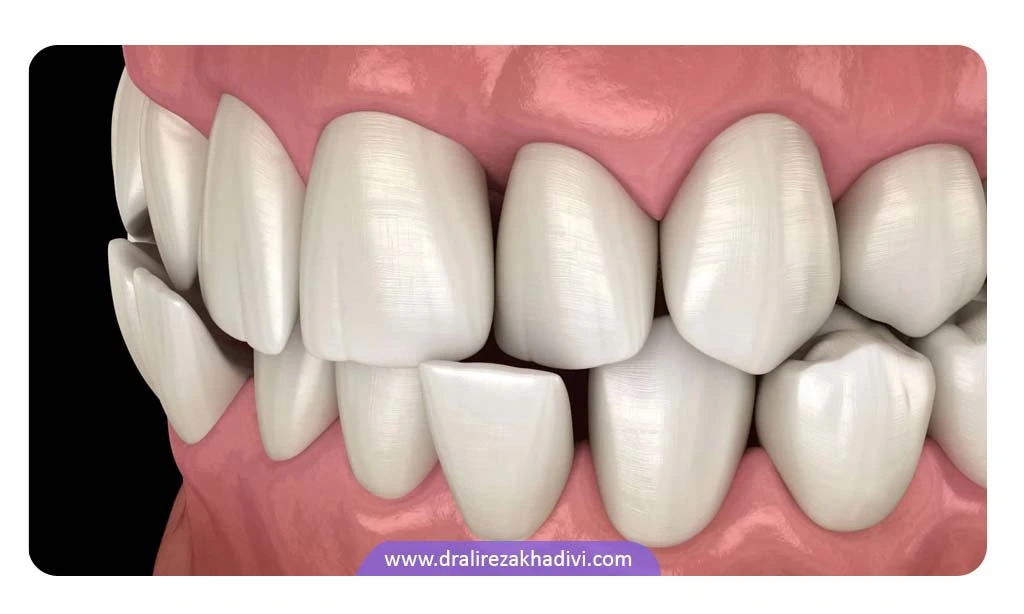 کراس بایت دندان به معنی قرار نگرفتن صحیح دندان ها روی هم است