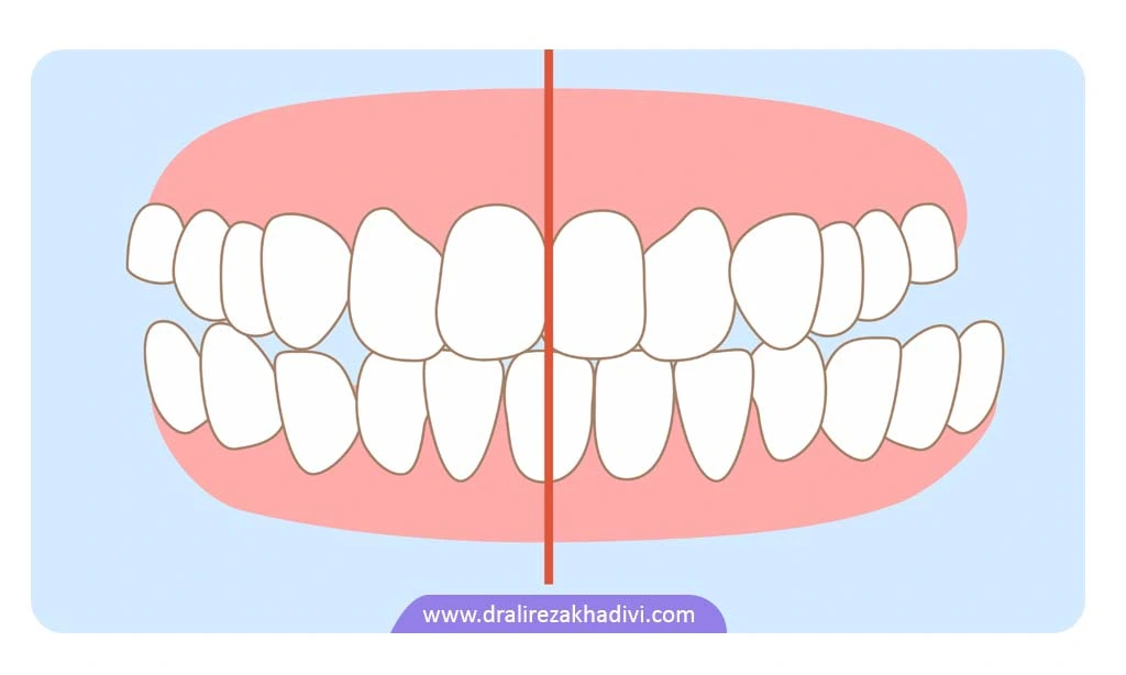 کراس بایت دندان انواع مختلفی دارد.