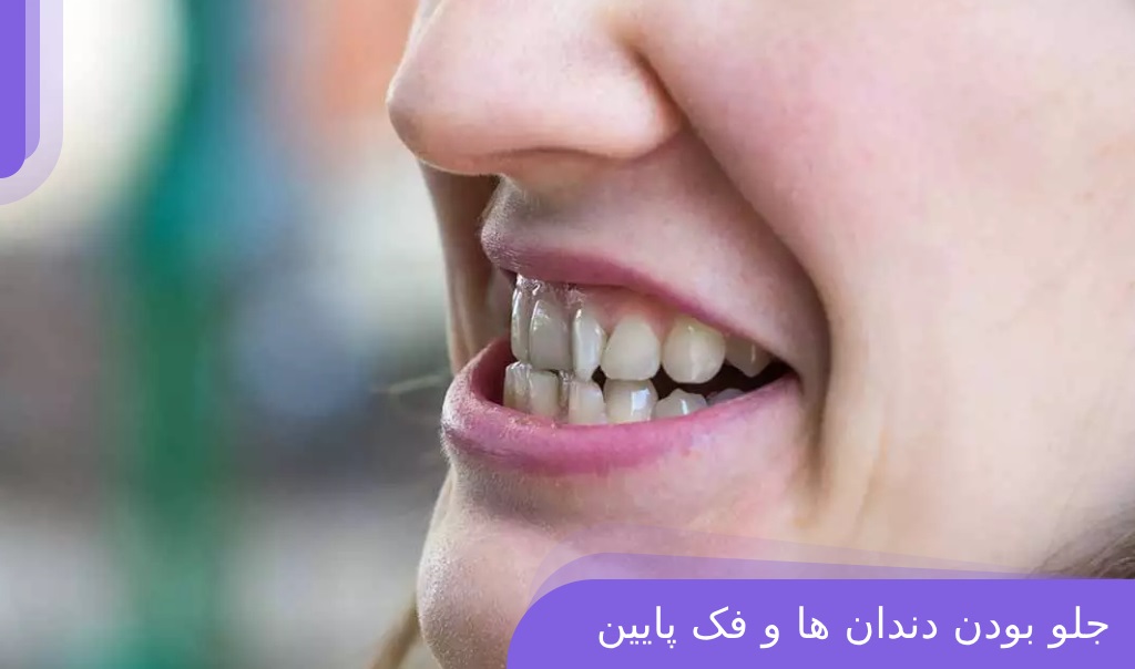 جلو بودن دندان پایین یا آندربایت