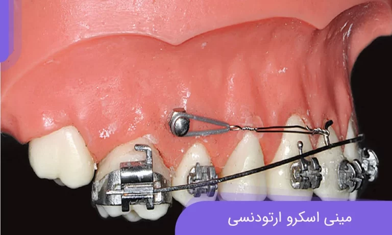 درمان مینی اسکرو ارتودنسی