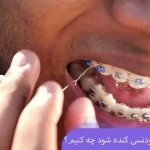 اگر براکت ارتودنسی کنده شود چه کنیم