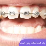 آیا ارتودنسی یک فک امکان پذیر است