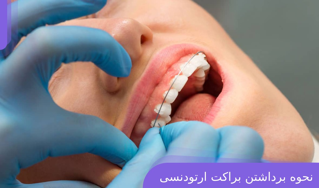 نکات برداشتن ارتودنسی از روی دندان