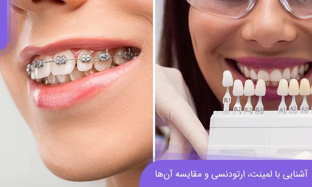 ارتودنسی و لمینت، دو روش بهبود و اصلاح دندان‌ها هستند.