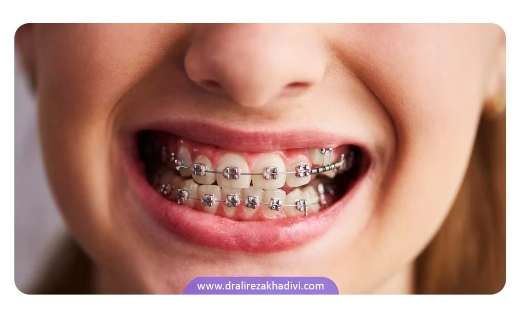 انتخاب لمینت یا ارتودنسی، به شرایط دندان‌های افراد بستگی دارد.