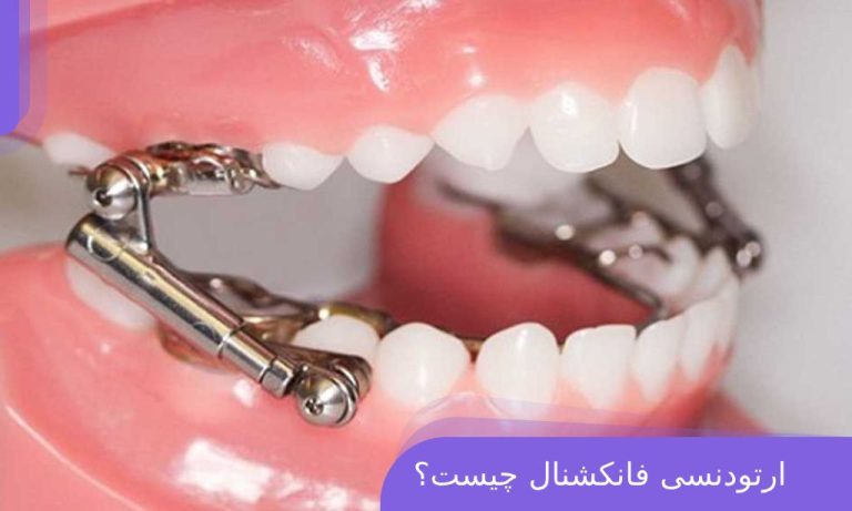 ارتودنسی فانکشنال