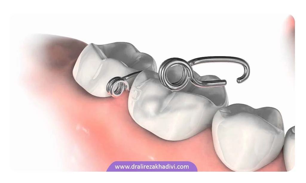 مزایای استفاده از جداکننده ارتودنسی برای تنظیم فاصله بین دندان ها