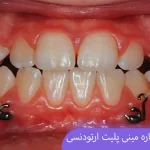 همه چیز درباره مینی پلیت ارتودنسی