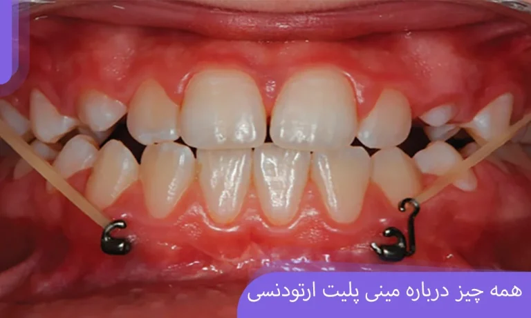 همه چیز درباره مینی پلیت ارتودنسی