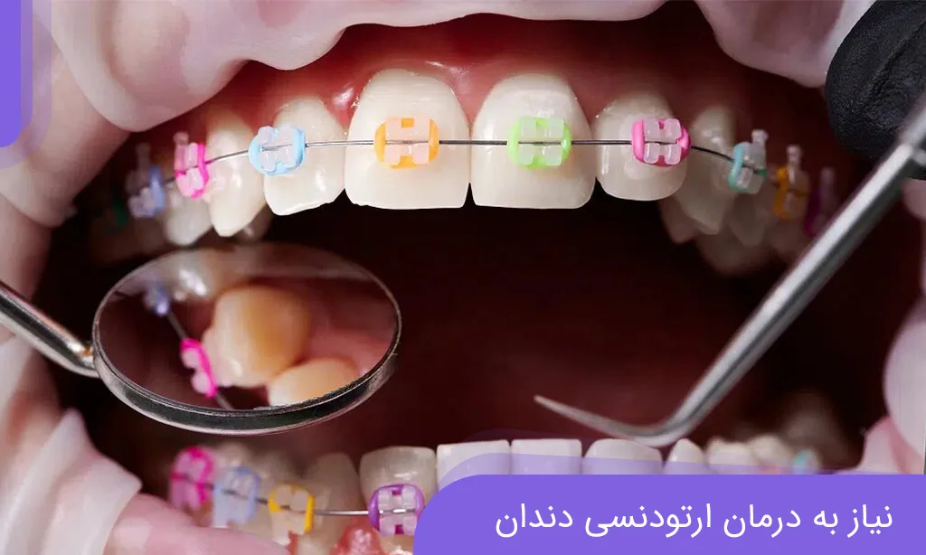 نیاز به درمان ارتودنسی برای سلامت و زیبایی دندان
