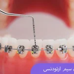سفت کردن سیم ارتودنسی