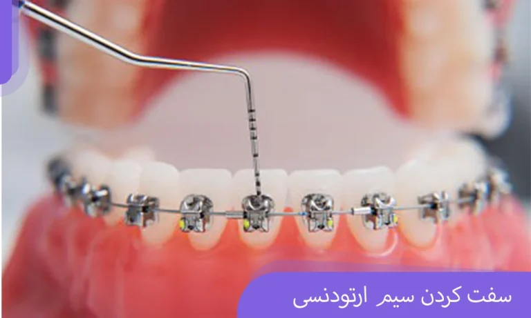 سفت کردن سیم ارتودنسی
