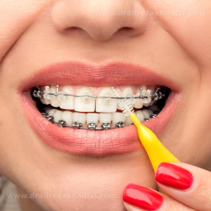 نخ دندان کشیدن حین ارتودنسی