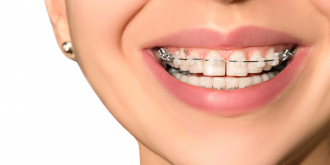 بهترین مزایا و فواید ارتودنسی دندان