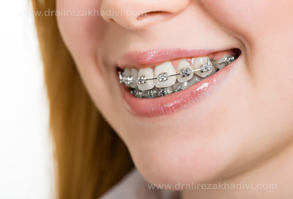 ارتودنسی ثابت ارتودنسی ثابت