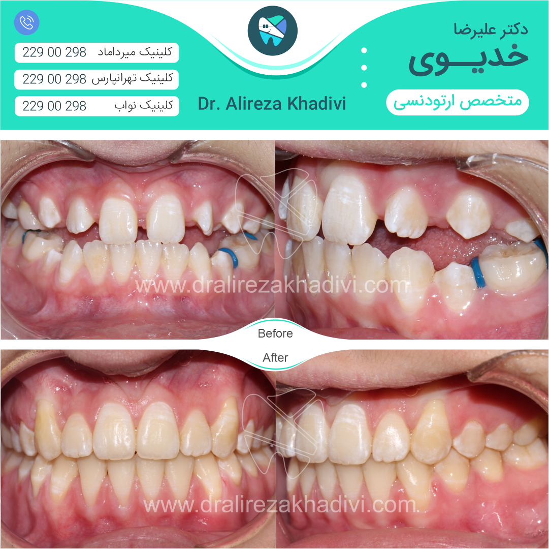 قبل و بعد ارتودنسی توسط دکتر خدیوی