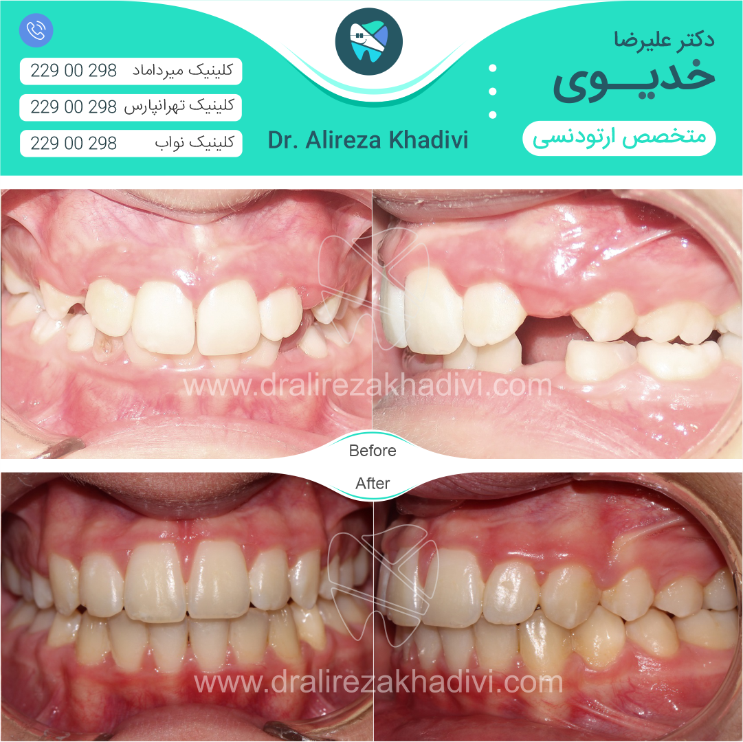 نتیجه درمان ارتودنسی توسط دکتر خدیوی