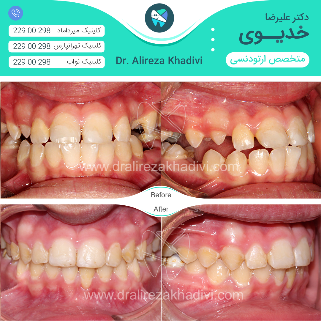 نمونه درمان ارتودنسی در کلینیک تخصصی دکتر خدیوی