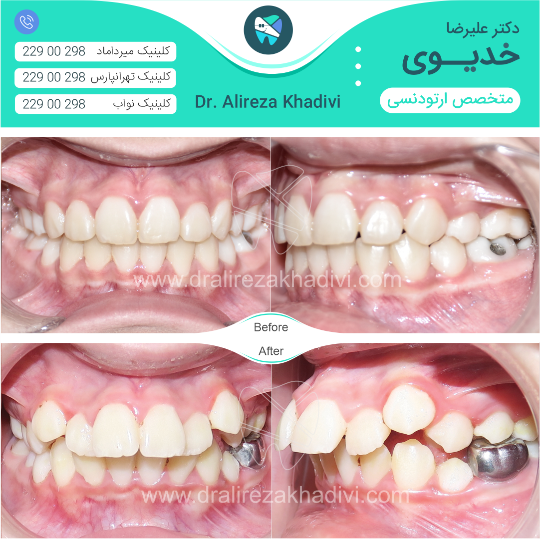 نمونه درمان ارتودنسی تویط دکتر خدیوی
