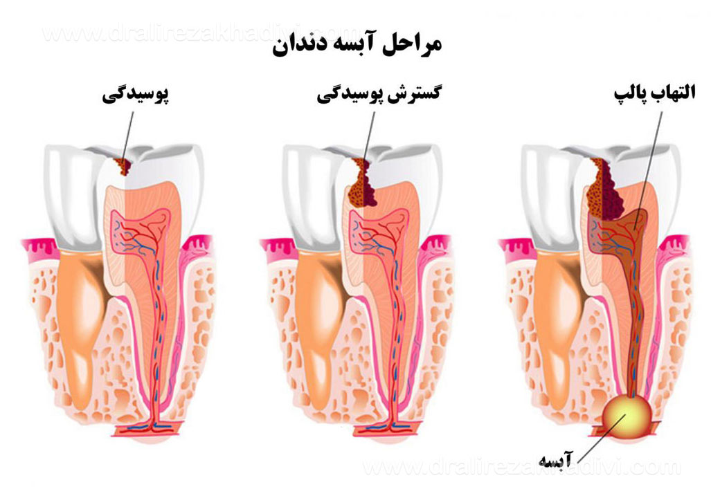 آبسه دندان