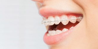 مزایا و فواید ارتودنسی دندان
