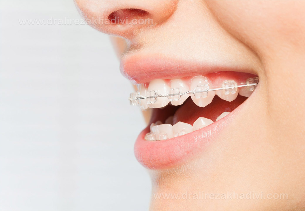 مزایا و فواید ارتودنسی دندان