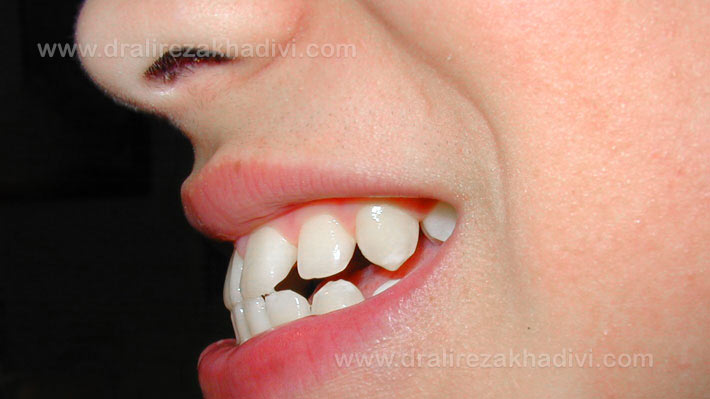 اوربایت دندان