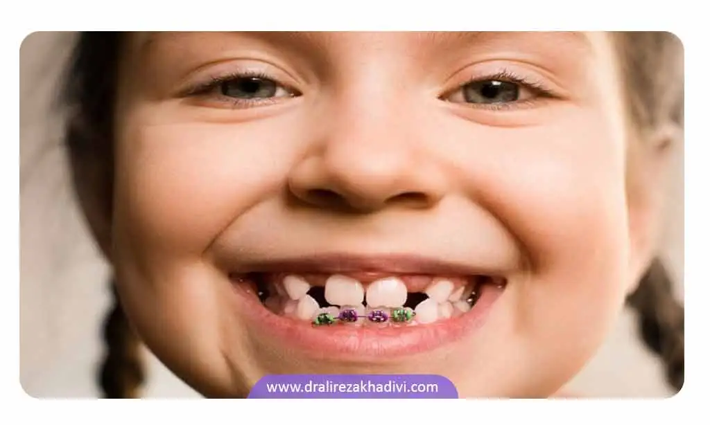 ارتودنسی تک دندان برای مرتب کردن تعداد کمی از دندان ها انجام می شود