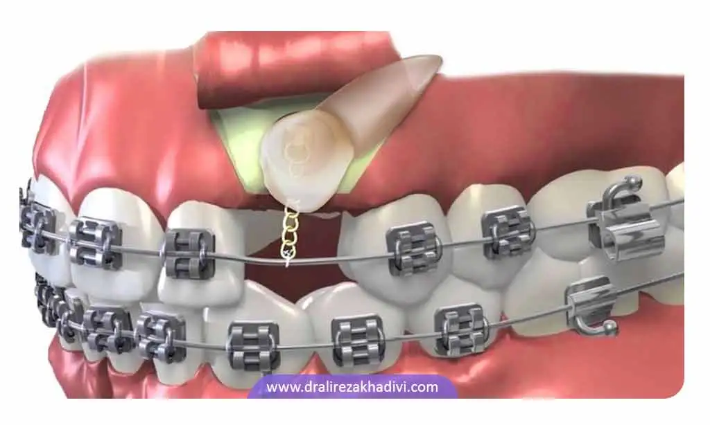 می توان کج بودن یک دندان را با ارتودنسی برطرف کرد تا نیاز به کشیدن آن نباشد.