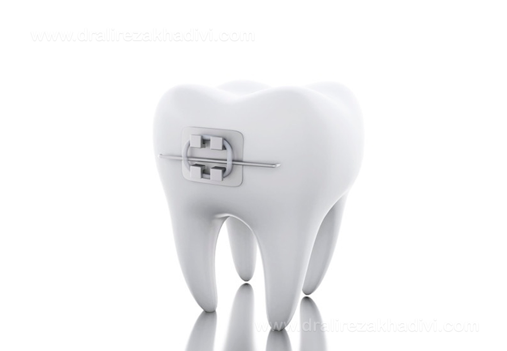 ارتودنسی یک دندان
