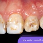 پوسیدگی دندان در ارتودنسی - علائم و عوامل