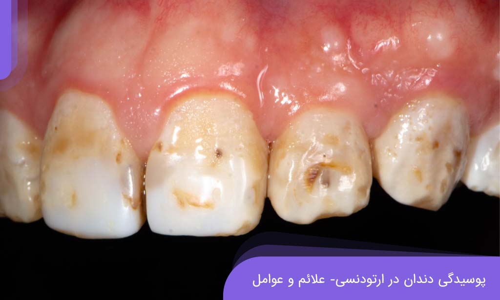 پوسیدگی دندان در ارتودنسی - علائم و عوامل