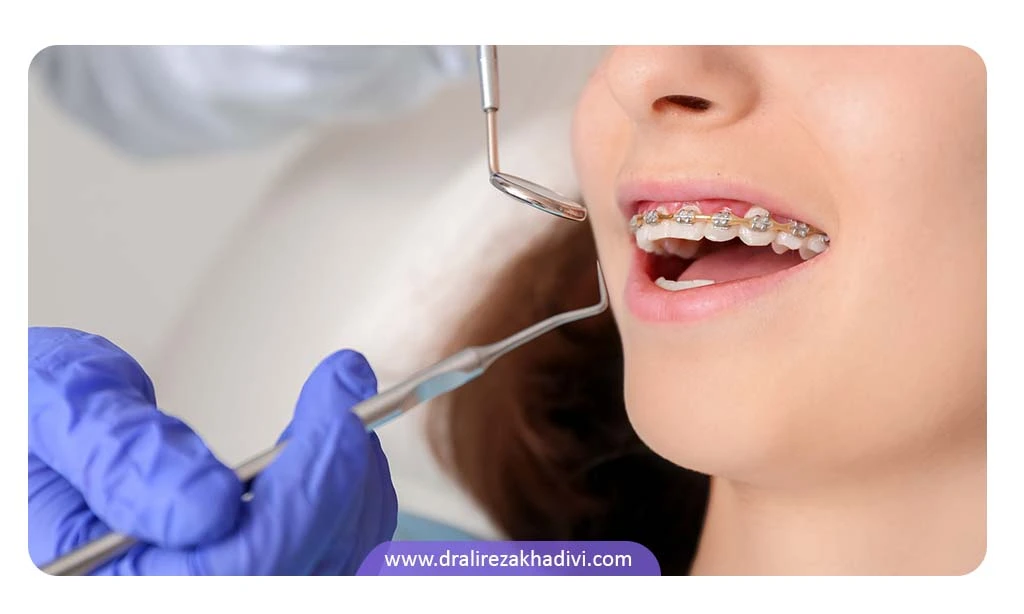 علائم پوسیدگی دندان در ارتودنسی چیست