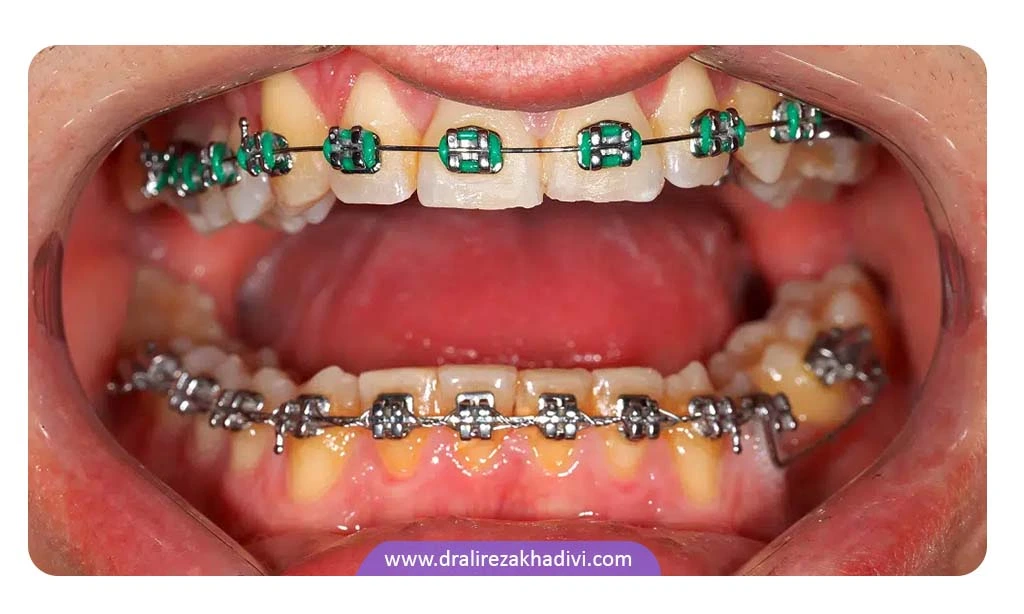 جلوگیری از پوسیدگی دندان در ارتودنسی چگونه اتفاق می افتد؟
