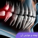 دندان عقل نهفته و عوارض آن