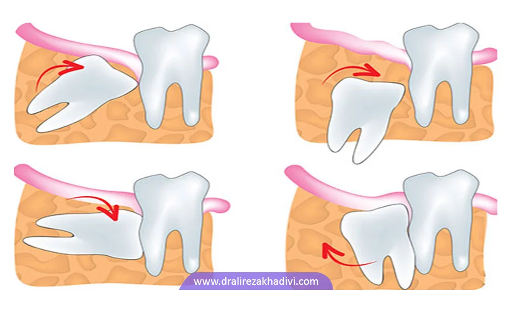 شکل انواع دندان عقل نهفته