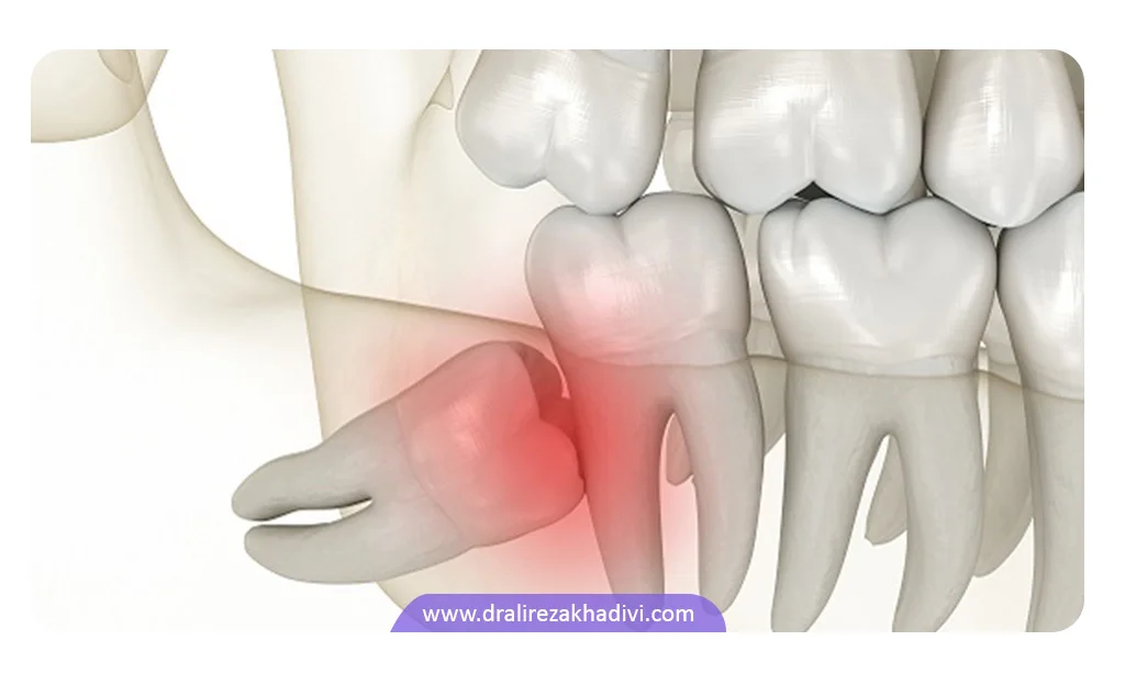 آسیب دندان عقل نهفته به دندان‌های مجاور