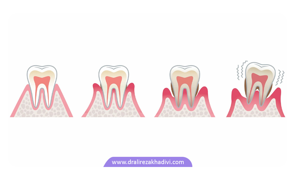 مراحل پیشروی بیماری لثه پریودنتیت که موجب آسیب به بافت لثه و دندان می شود.