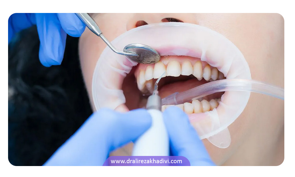 روند درمان عفونت لثه توسط دندانپزشک